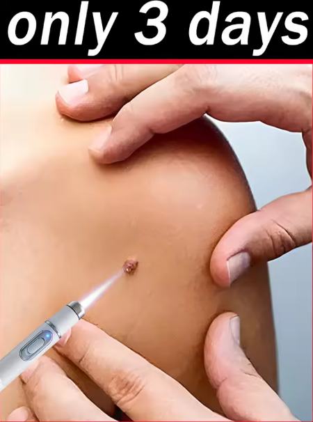 1st generation upgraded wart remover ⸴ Wart treatment ⸴ Fast