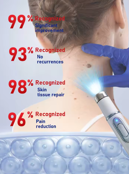 1st generation upgraded wart remover ⸴ Wart treatment ⸴ Fast